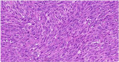 Case report: Responses to the combination of gemcitabine with sirolimus in two patients with TSC-mutated sarcomas